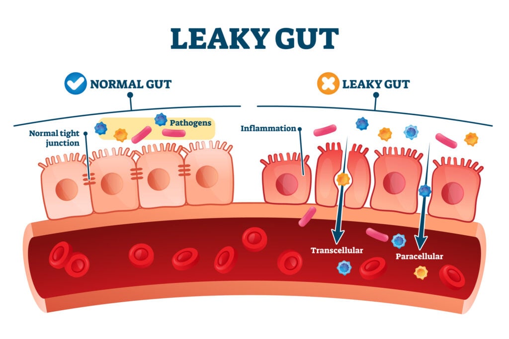 leaky gut diagram showing how the zonulin or tight junctions between the cells of the gut lining look with leaky gut