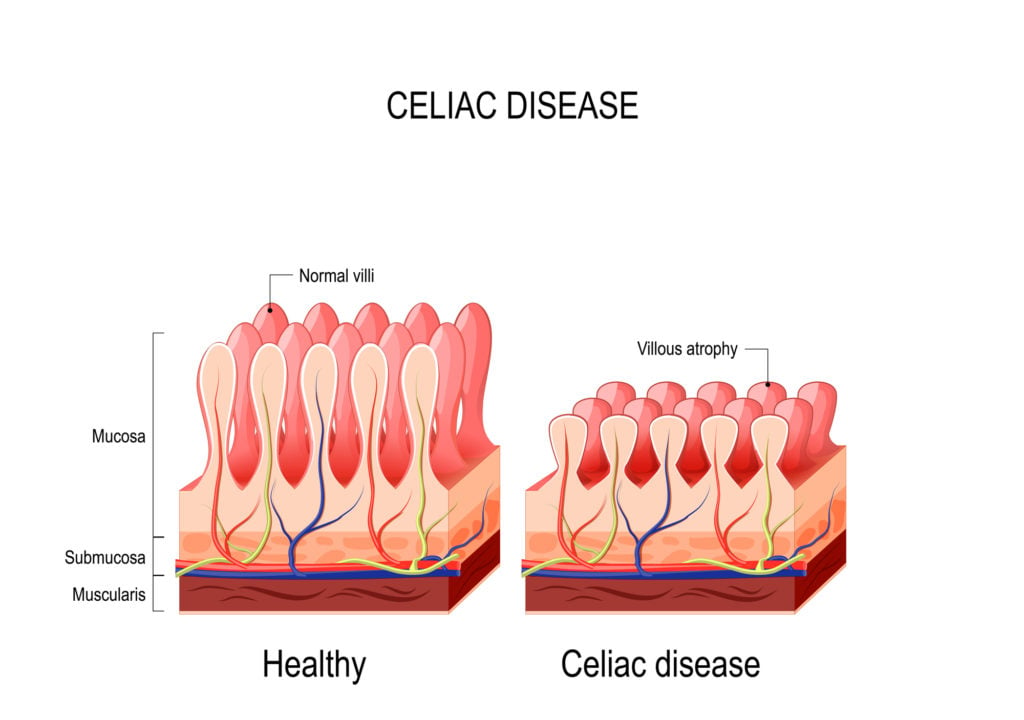 Diagram of what happens to small intestine in celiac disease