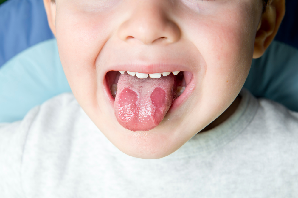 child with geographic tongue