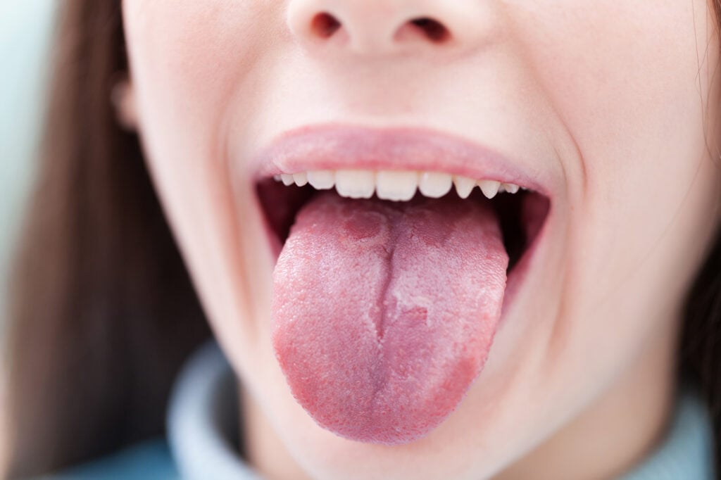 A girl showing geographic tongue spots on her tongue