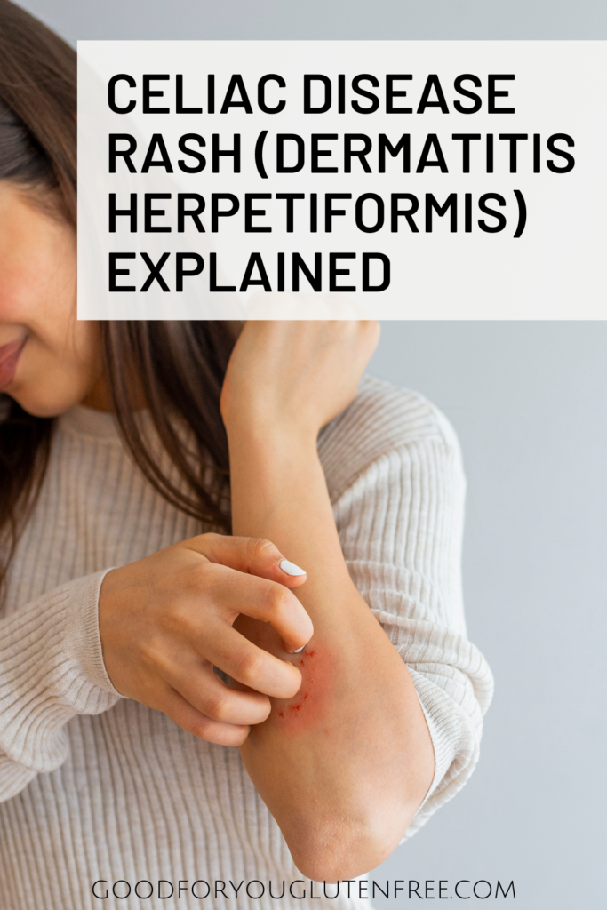 Celiac Disease Rash (Dermatitis Herpetiformis) Explained - Good For You Gluten Free