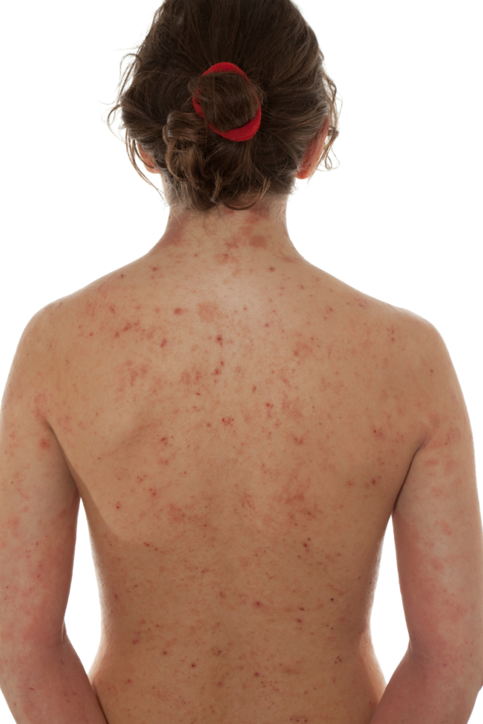Celiac rash on back of woman