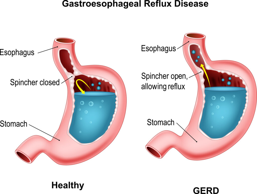 GERD graphic showing acid reflux