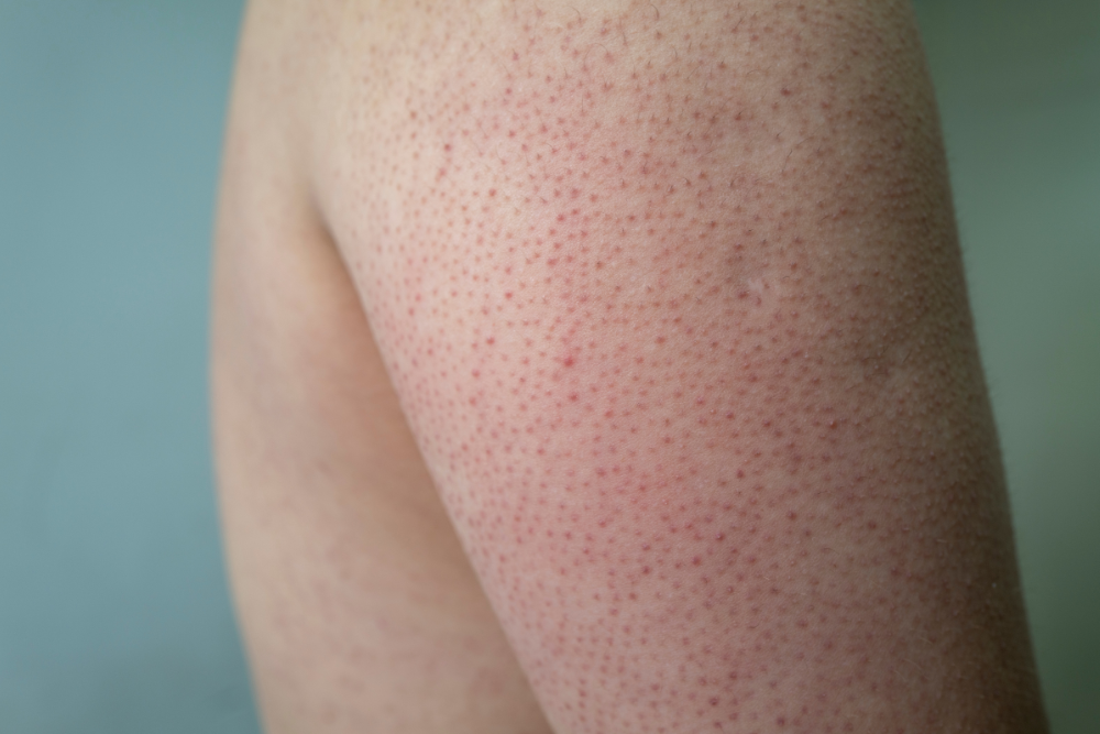 Keratosis Pilaris and the Gluten (Celiac Disease) Connection